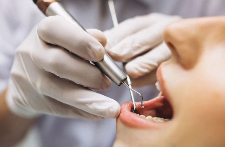 Desmineralização dental: o que é e como ocorre